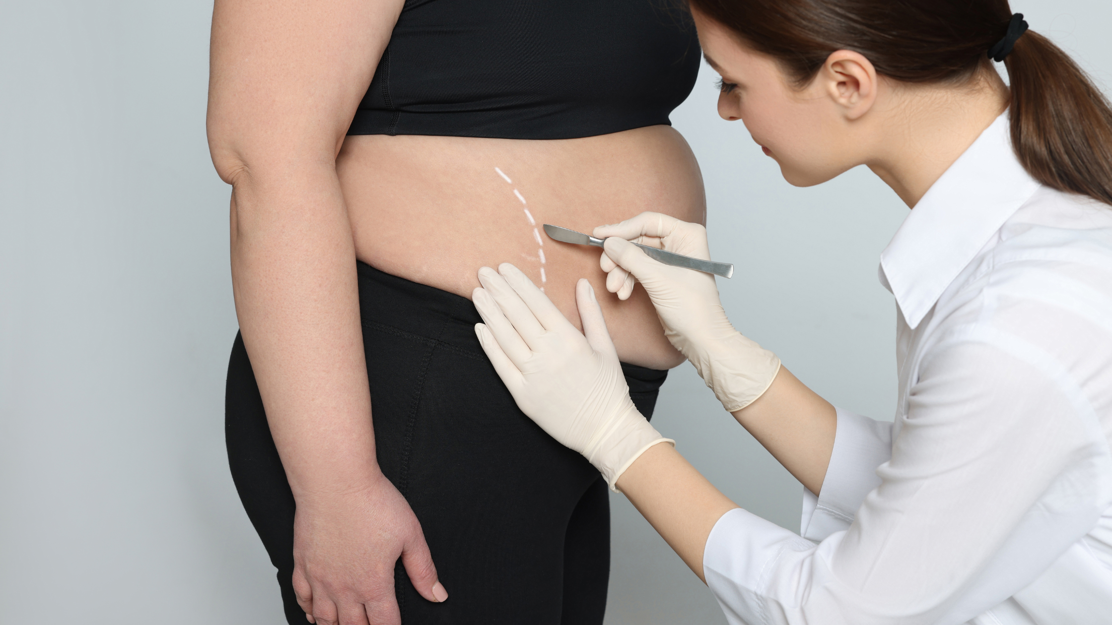 Cirurgia Bariátrica Sleeve Gástrico
