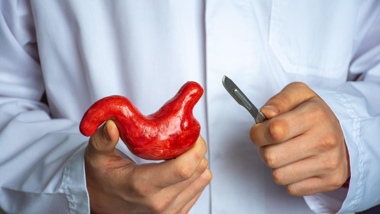 Cirurgia bariátrica pelo convênio Amil: entenda as regras e como acelerar o processo