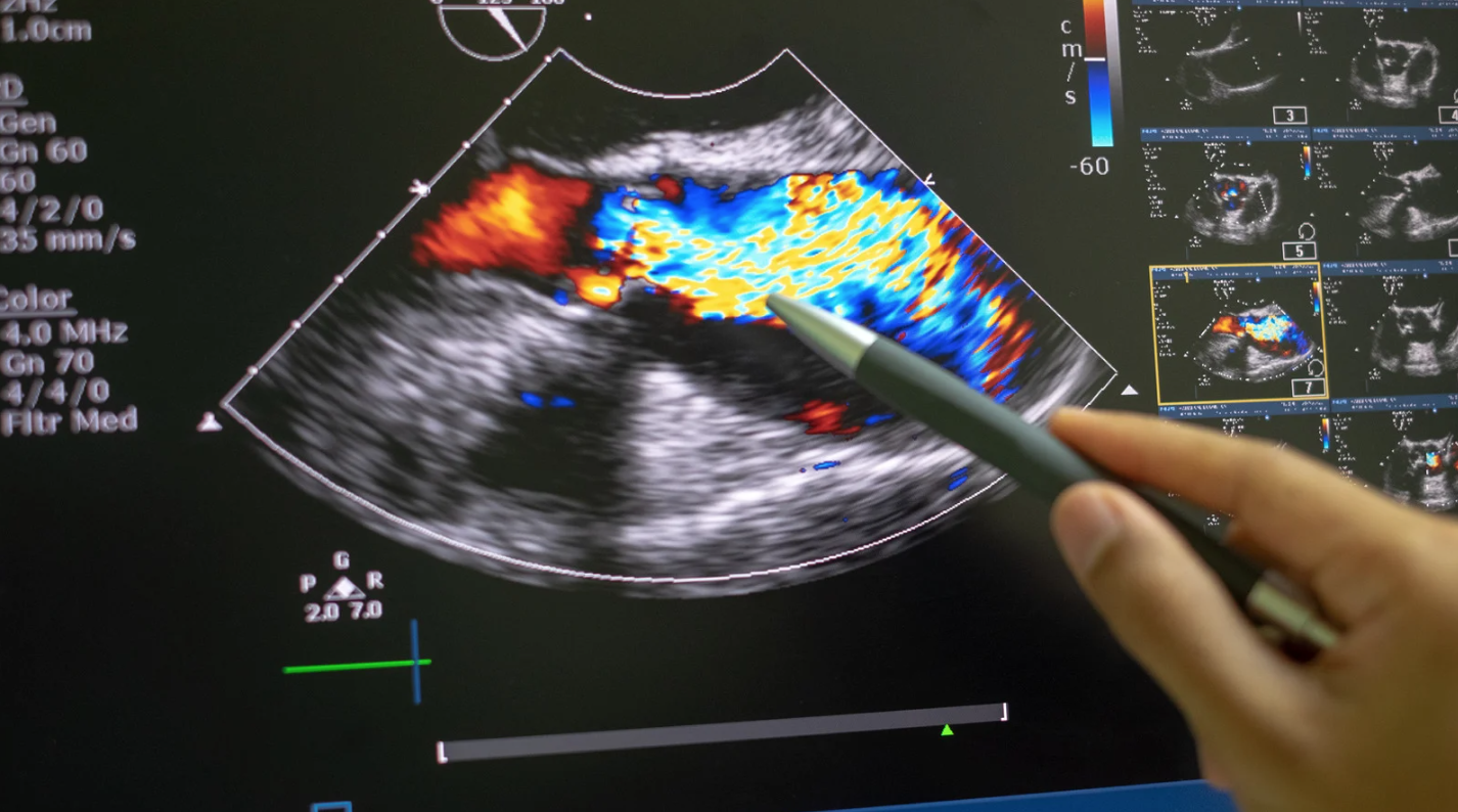 Agendar ecocardiograma com Doppler colorido em São Paulo na Clínica Bellit