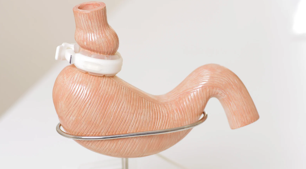 Balão intragástrico ou cirurgia bariátrica
