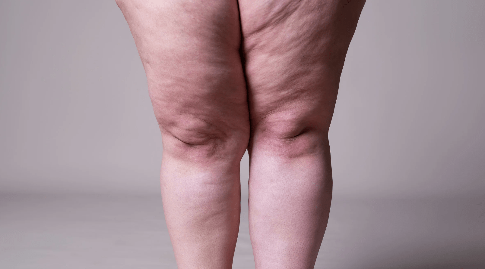 Tratamento de Lipedema com Mounjaro e Dieta Anti-inflamatória