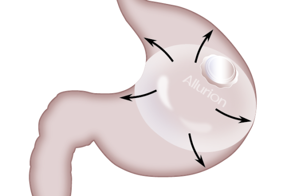 Allurion_Balloon_Illustration_watermark